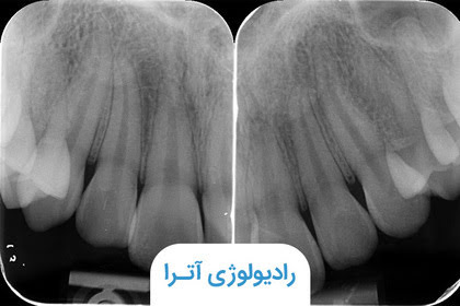 رادیوگرافی پری اپیکال چیست و چه کاربردی دارد؟